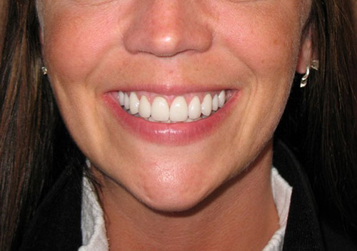 Before and after smile