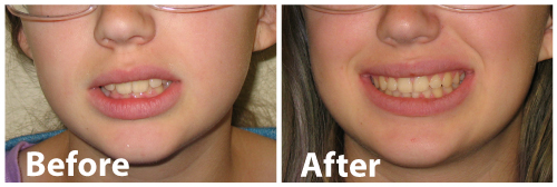 Before and after smile