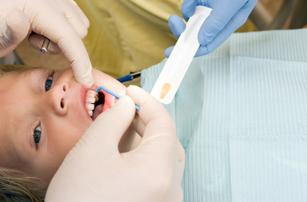 Young boy receiving fluoride treatment at Century Dental in Hillsboro, OR